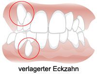 Frontalansicht eines Kiefers mit Zahnengstand